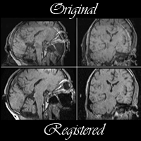 Brain Tumor Resection